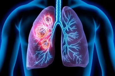 IASLC incorpora nova medida histológica na 9ª classificação TNM do câncer de pulmão