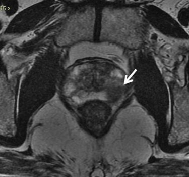 Neoplasia prostatica