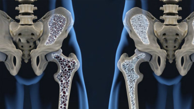 osteoporose bx