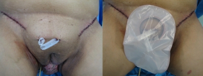 carcinoma vulva icesp bx