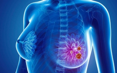 Esquema triplo mostra benefício de SLP no câncer de mama HER2+/ HR+
