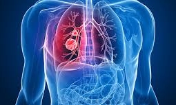 Estudo de mundo real avalia pneumonite no CPCNP em pacientes tratados com durvalumabe