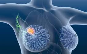 BEGONIA: combinação mostra resultados no câncer de mama triplo negativo