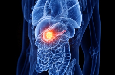 TAPUR: olaparibe mostra eficácia no câncer de pâncreas com mutação BRCA1/2
