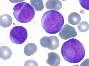 Leucemia_promielocitica_aguda.jpg