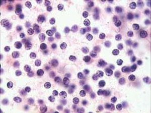 Linfoma_C__lula_Manto_NET_OK.jpg