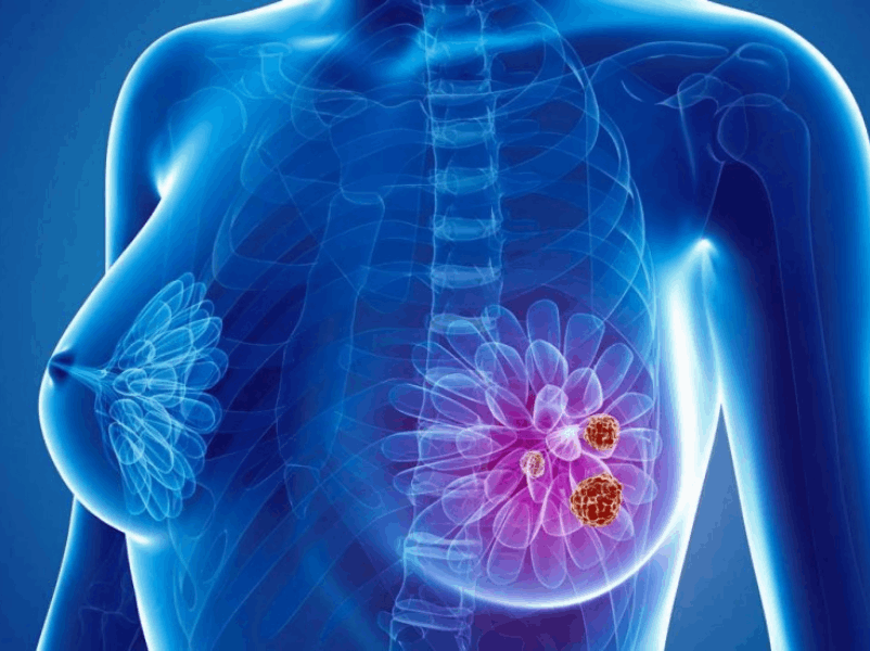 Teste multigênico e valor prognóstico no câncer de mama