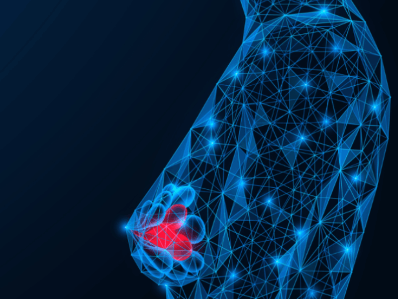 Modelo baseado em inteligência artificial mostra valor preditivo no câncer de mama